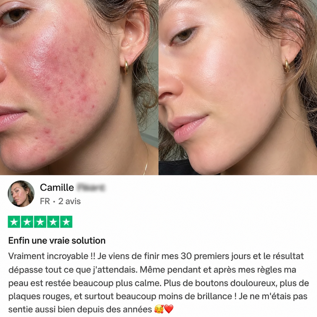 Cure Acné Hormonale — image 6