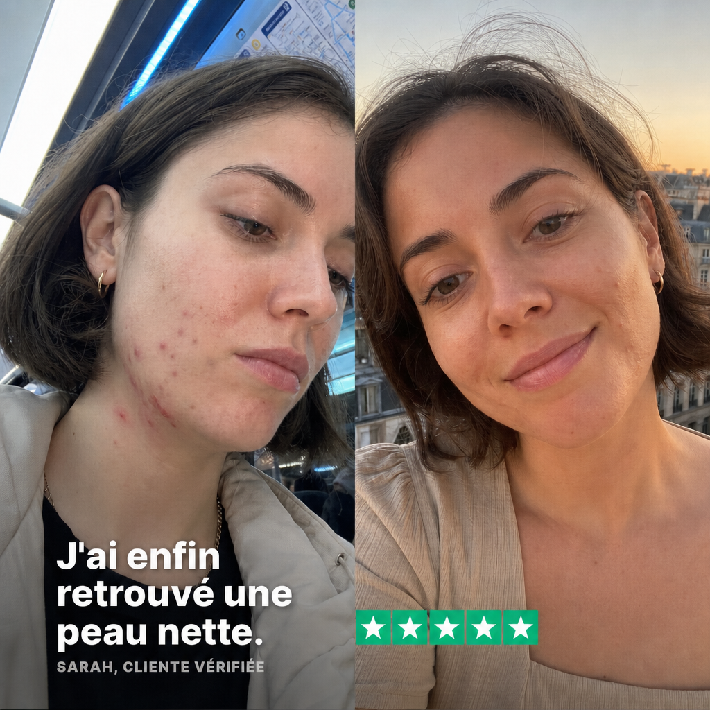 Cure Acné Hormonale
